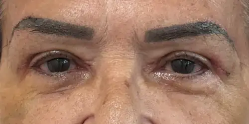 Caso 3, depois (pós recente)